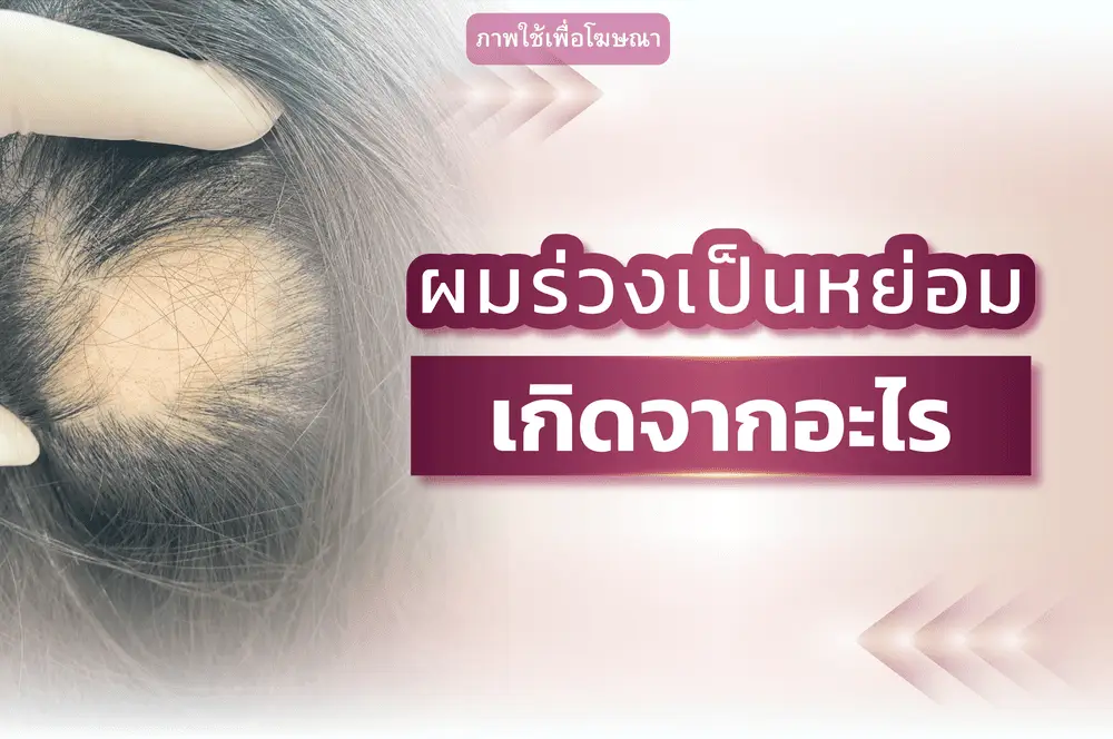 ผมร่วงเป็นหย่อมเกิดจากอะไร? สาเหตุและวิธีดูแล