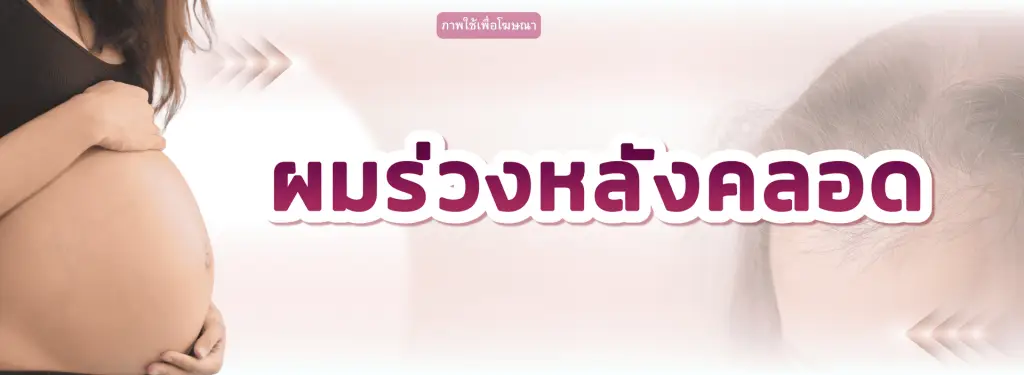ผมร่วงหลังคลอด สาเหตุ ระยะเวลา และวิธีดูแล | Wellnis